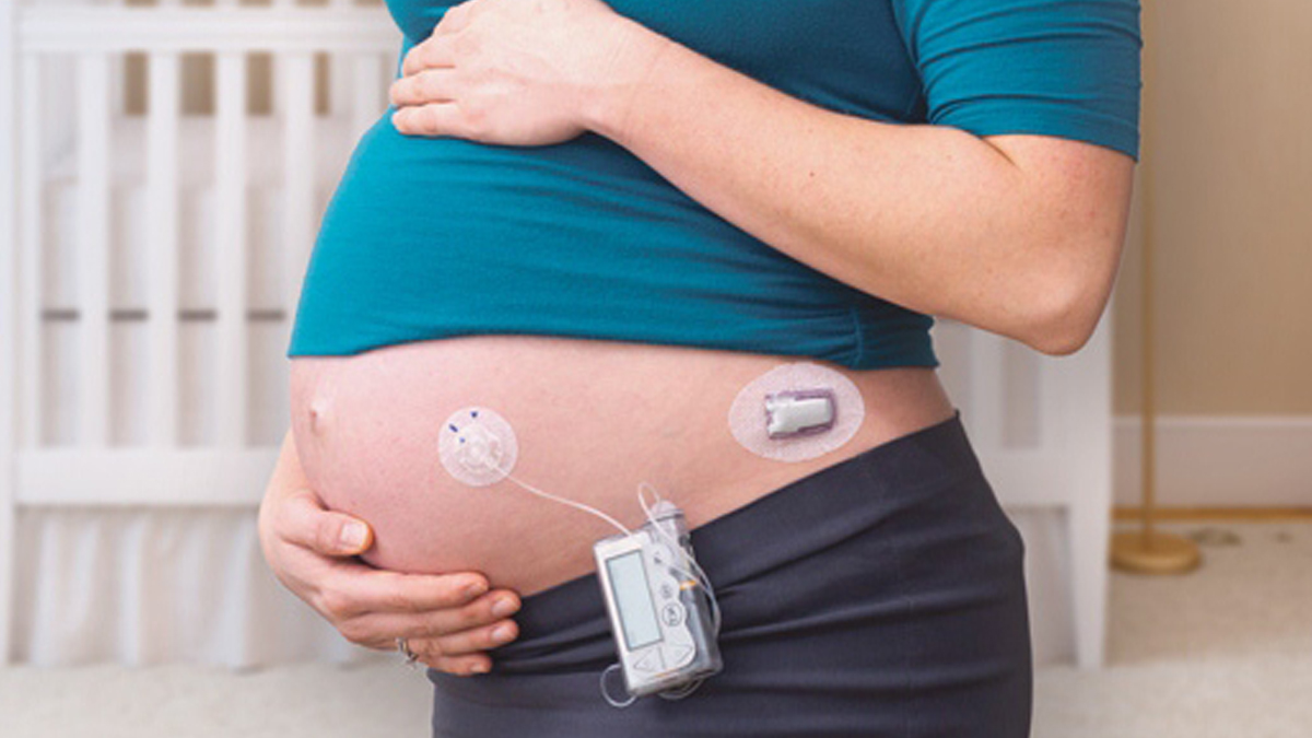 Pregnant woman wears CGM and insulin pump