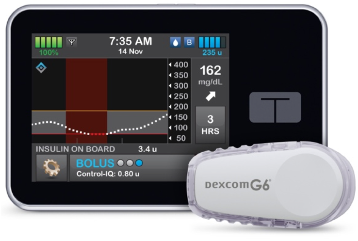 Tandem Control-IQ—Now Authorized For Children