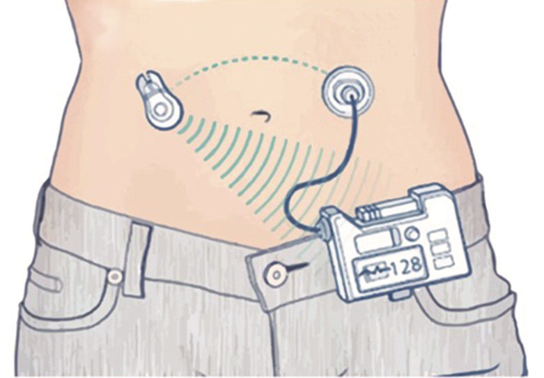 Illustration of artificial pancreas system